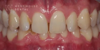 Close-up clinical view of a patient’s upper front teeth following orthodontic straightening and gum line correction. The teeth show minor unevenness and small chips at the biting edges, captured as a 'before' shot for dental edge bonding treatment.